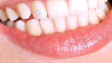 Totul despre bijuteriile dentare