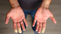 Ce se întâmplă în corp când ai sensibilitate la frig: cum se modifică degetele