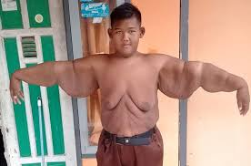 Transformare spectaculoasă! Arya Permana, poreclit „cel mai gras copil din lume”, a slăbit peste 100 de kilograme. Cum arată acum băiatul