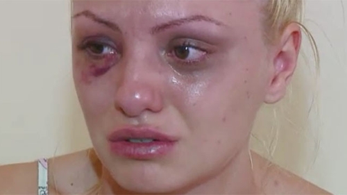 Alexandra Stan ajunge la cutit din cauza impresarului bataus. Afla aici de ce sufera artista si cand se va opera!