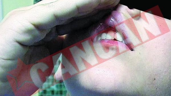 Amuscat de nas un copil
