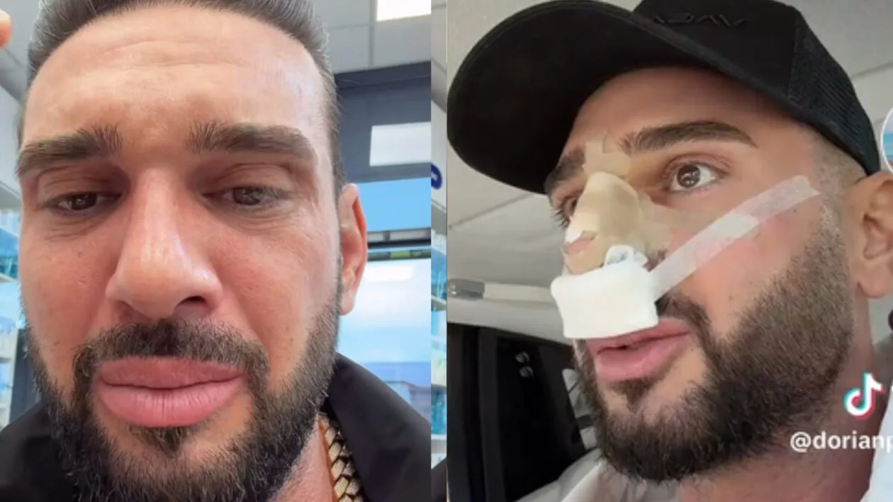 Ce probleme are Dorian Popa după operația la nas. Influencerul a recunoscut: „Nu-l simt așa încă al meu”