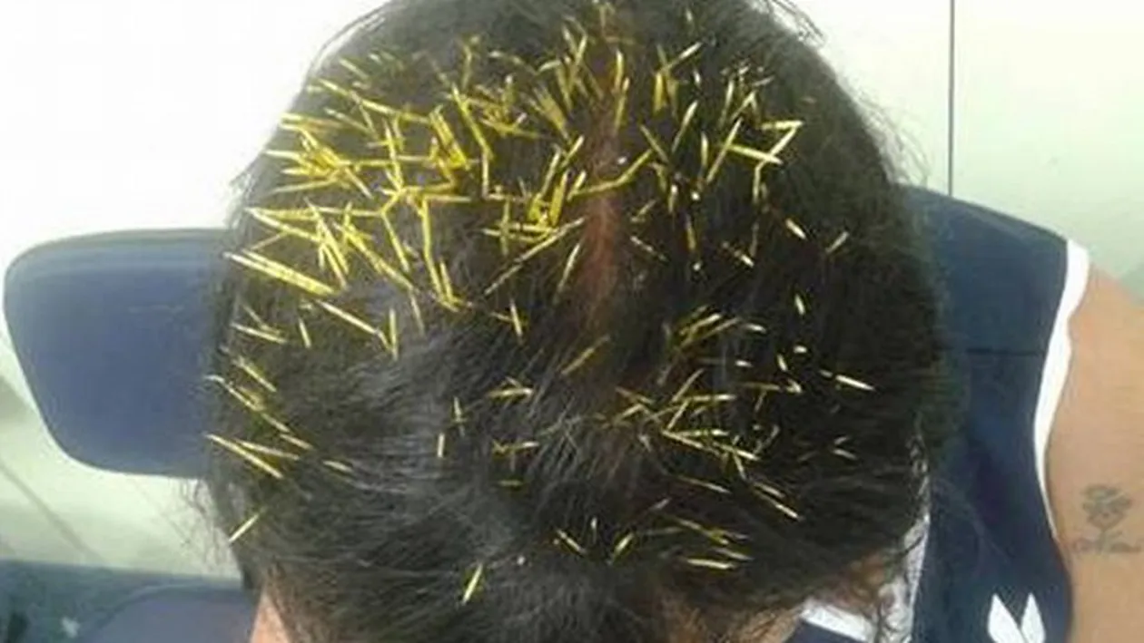 Pare IMPOSIBIL, dar s-a intamplat! Ce i-a cazut in CAP unei femei, in timp ce isi plimba cainele!Medicilor nu le-a venit sa creada