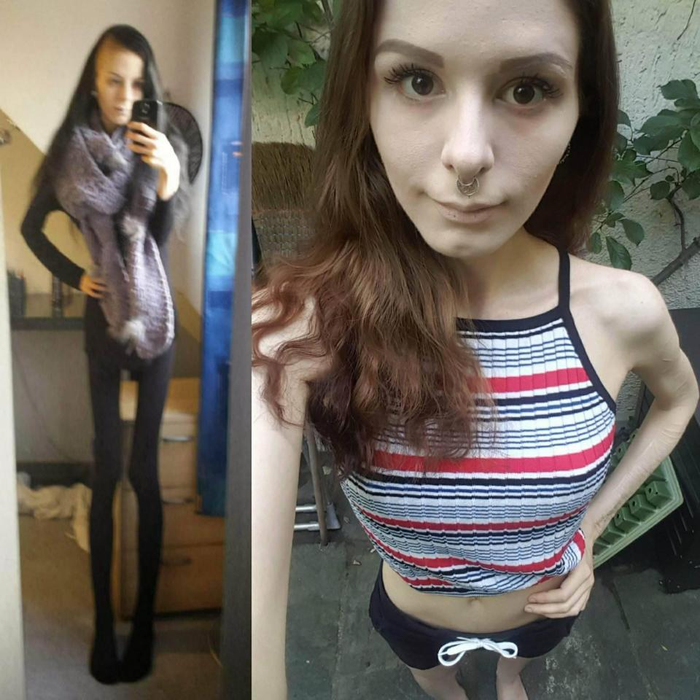 Cazul şocant al fetei care îşi ascundea mâncarea în urechi! Julia cântărea 32 de kilograme, dar a învins anorexia. Cum a reuşit!