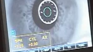 INCREDIBIL! Un vierme de 10 centimetri a crescut in ochiul unui barbat! VEZI cum a ajuns acolo!