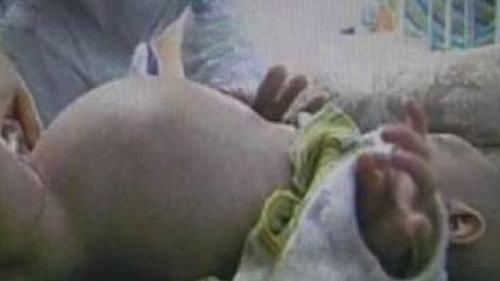A uimit lumea medicală! Un băieţel de numai doi ani şi-a născut propriul FRATE! VIDEO IREAL