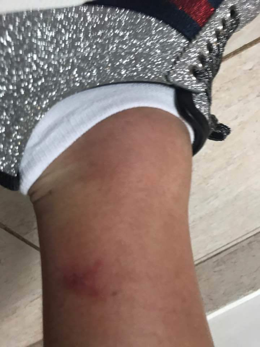 Adrian Minune s-a ales cu un picior bandajat