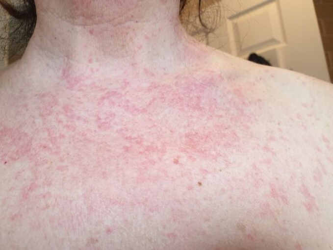 Eczema de pe gât și piept