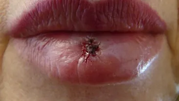 Geluri naturale pentru buzele crapate