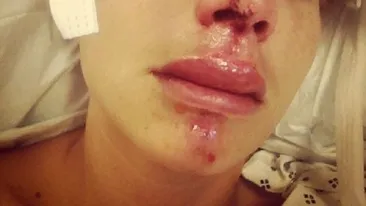 ŞOCANT! O gimnastă a fost desfigurată! Blonda superbă a fost mutilată după ce a încercat o cascadorie simplă!