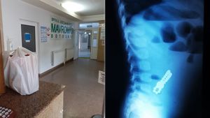 Trei copii din Botoșani, operați de urgență după ce au ajuns la spital cu perforații la nivelul intestinului: “Acești magneți sunt foarte puternici”. Semnalul de alarmă tras de medici