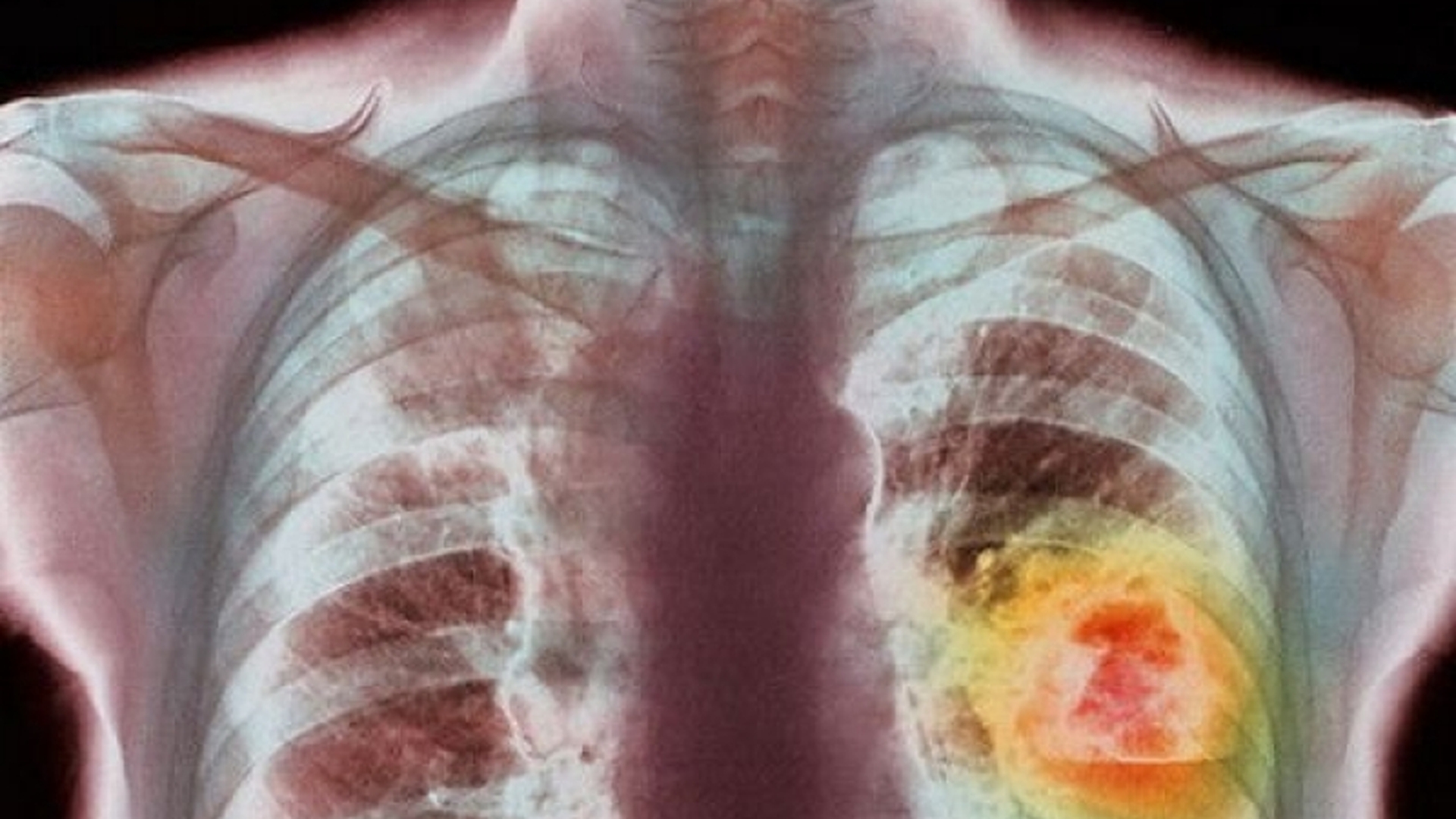 O asociație din Prahova a cumpărat un aparat de ultimă generație care ajută la depistarea a trei tipuri de cancer