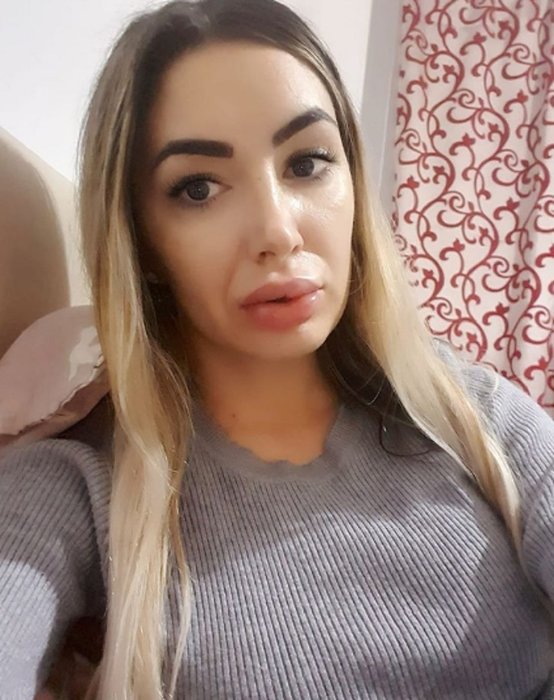 Prima imagine cu Sexy Brăileanca după ce și-a făcut intervenție estetică la nivelul feței