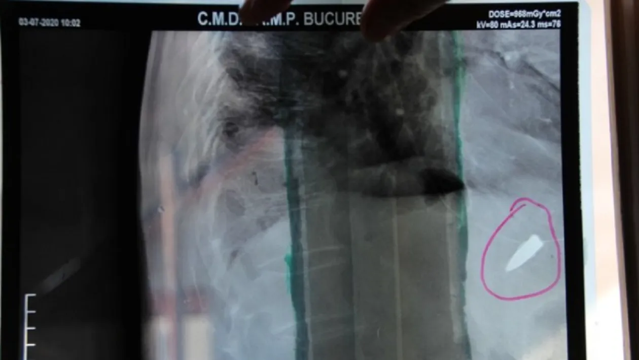 El este românul care trăiește de 80 de ani cu un glonț lângă inimă. Povestea care a făcut înconjurul lumii