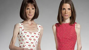 Anorexice pe viata! Doua gemene si-au jurat la 11 ani sa nu mai manance