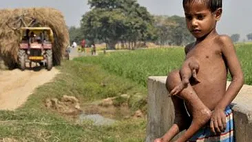 Copilul mutant! Ii ies din piept picioarele fratelui siamez mort