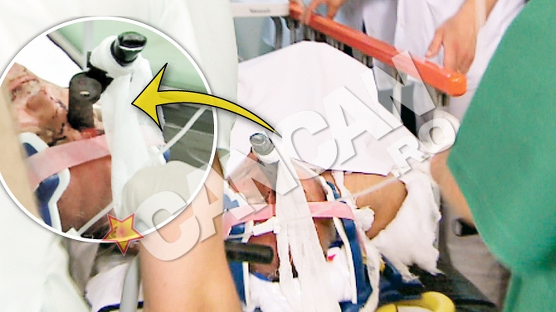 Barbatul ajuns la spital cu o foarfeca infipta in cap este in coma!