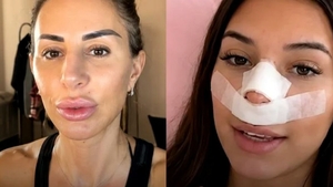 Val de reacții după ce o influenceriță s-a operat, pentru ca viitorii copii să nu îi moștenească nasul
