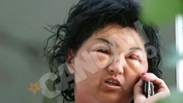 O femeie din Mehedinti a ajuns la Urgenta, mutilata de cosmetice! Vopseaua folosita era expirata!