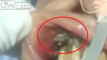 VIDEO & FOTO / Un stomatolog a rămas marcat pe viaţă. Ce a găsit în gura unui pacient! NU te uita dacă nu ai un stomac tare