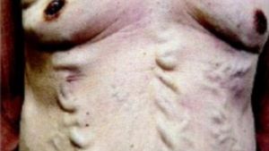 BOALA misterioasa de care sufera acest barbat. Cum a ajuns sa arate asa! Medicii nu au nicio explicatie