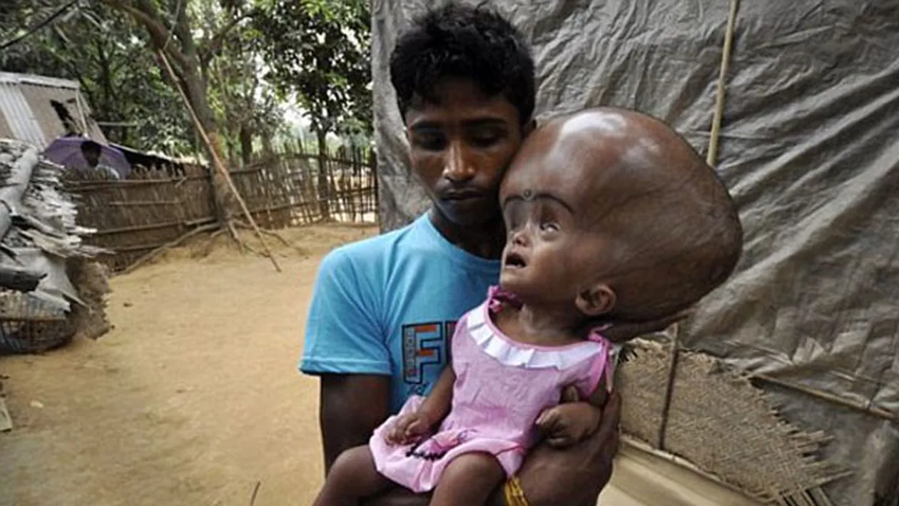 Imaginile cu ea au facut inconjurul lumii! ASA arata aceasta fetita inainte de operatie! Cum s-a transformat