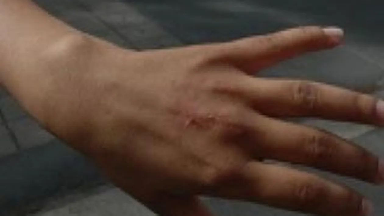 Un baiat de 17 ani din Sibiu a talharit doua tinere. Pe una dintre ele a muscat-o violent de mana