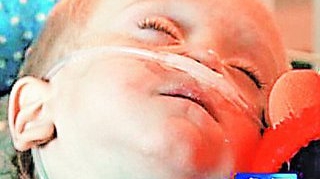 Un copil a suferit arsuri cumplite dupa ce a inghitit o baterie cu litiu. 18 operatii intr-un an