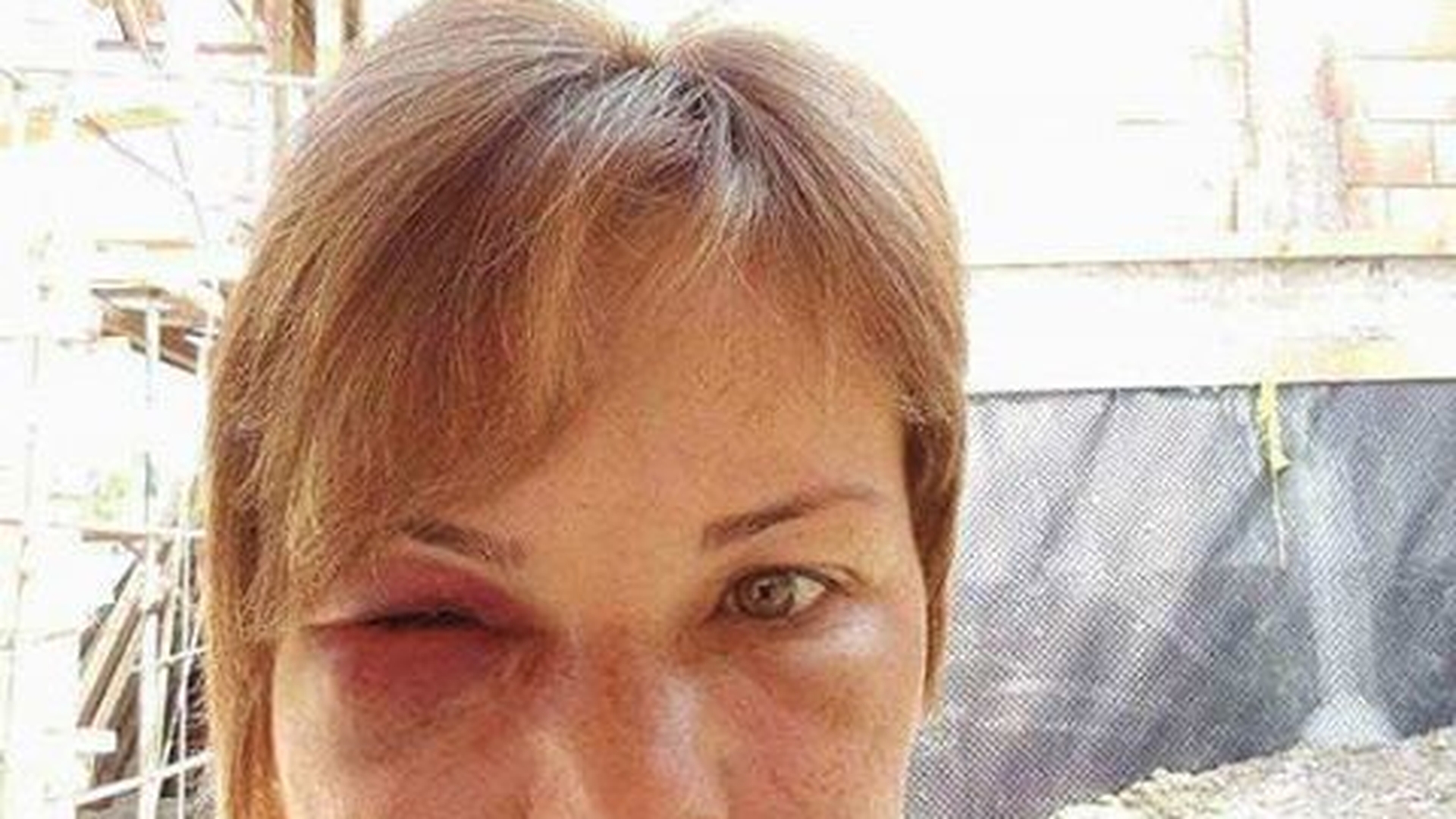 Atenţie, imagini cu un puternic impact emotional! A desfigurat-o stomatologul! I-a scos 4 măsele, iar rezultatul este TERIFIANT