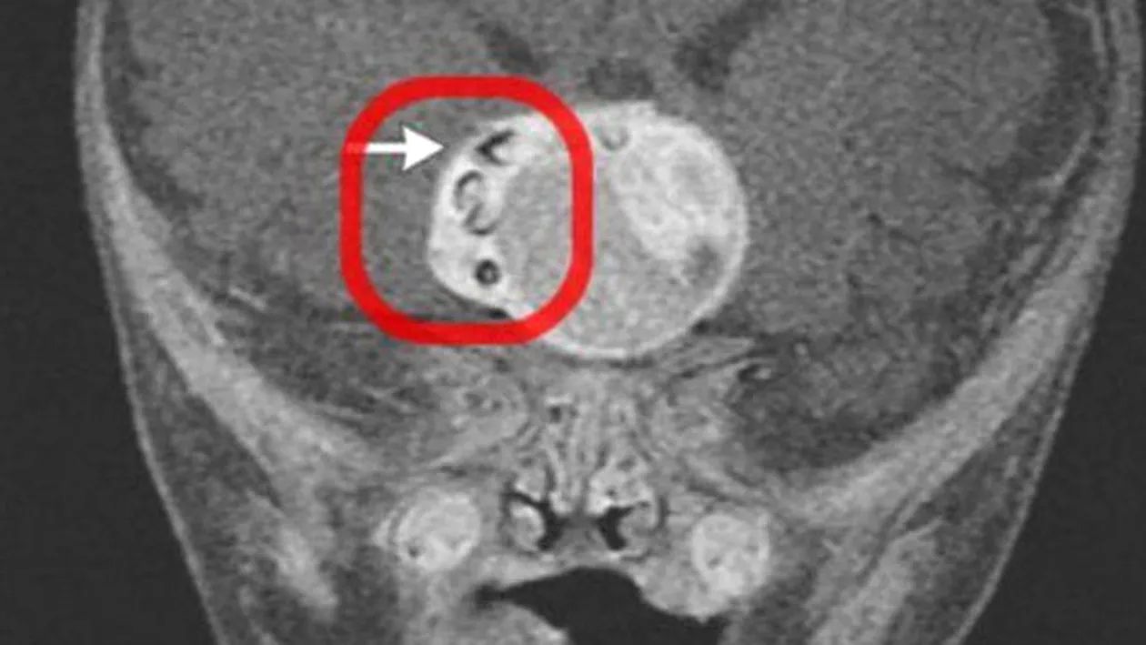 ATENTIE: Imagini socante! Doctorii au facut o descoperire BIZARA in creierul unui bebelus! Nu s-a mai auzit de una ca asta