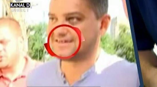 Cât îl va costa pe CRISTIAN BOUREANU noua dantură: „Nu mai are nicio şansă să…“