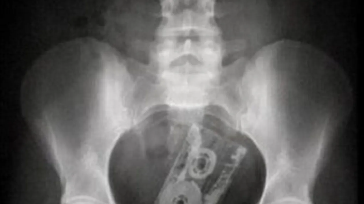 Sa vezi si sa nu crezi! Cele mai ciudate lucruri pe care oamenii si le baga in fund!