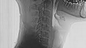 Ce au gasit medicii germani in gatul unui tanar din Afganistan. Avrea 10 centimetri si se afla in trupul barbatului din copilarie