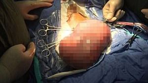 Un copil de opt ani a fost operat de urgenţă, după ce "burta lui era pe punctul de a exploda" pentru că nu putea merge la toaletă! Doctorii i-au scos 3 kg de excremente de mărimea unei mingi de baschet