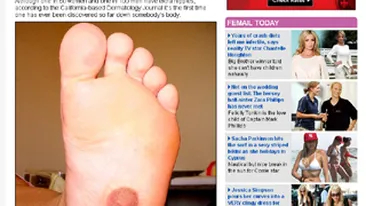 Unei femei de 22 de ani i-a crescut un sfarc in talpa