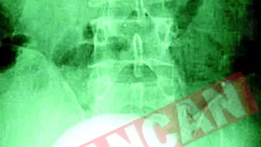 A avut o piatra la rinichi de peste un kilogram