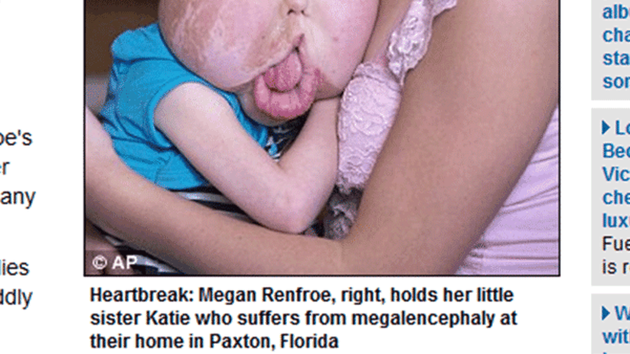 Cazul ei a pus în dilemă lumea medicală! O fetiţă din Anglia suferă de o boală care i-a mărit trăsăturile feţei anormal de mult