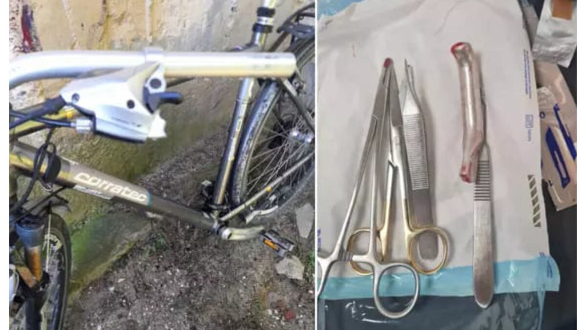Declarațiile uluitoare ale medicului din Urlați, care a cusut maneta unei frâne de bicicletă în piciorul unui pacient: "Îmi cer scuze pentru eveniment"
