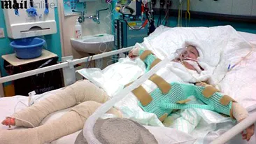 A suferit arsuri grave dupa ce i-a luat foc pijamaua cand statea langa aragaz