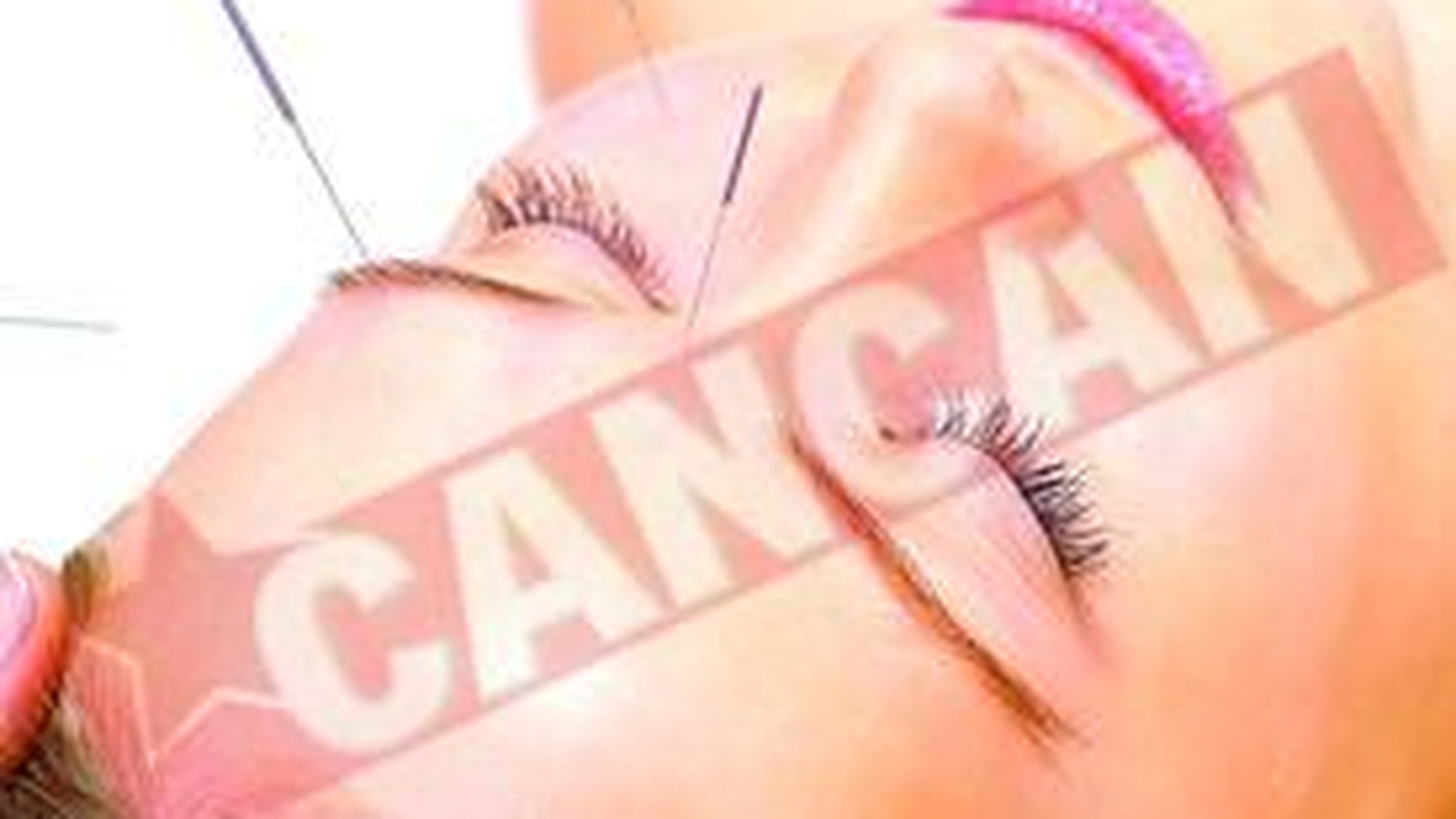 Cand va doare capul faceti acupunctura!