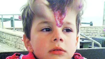 Ca sa scape de un semn oribil de pe frunte, un baietel a ajuns sa arate ca un dracusor! I-au pus coarne