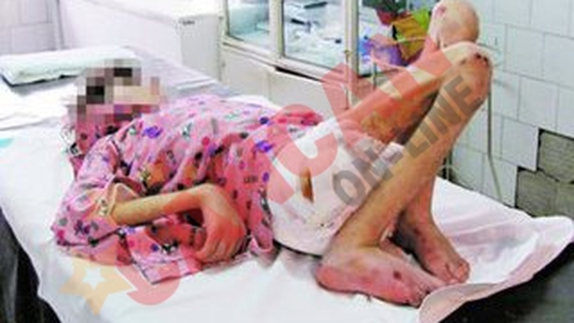 Fata-schelet a murit in spital