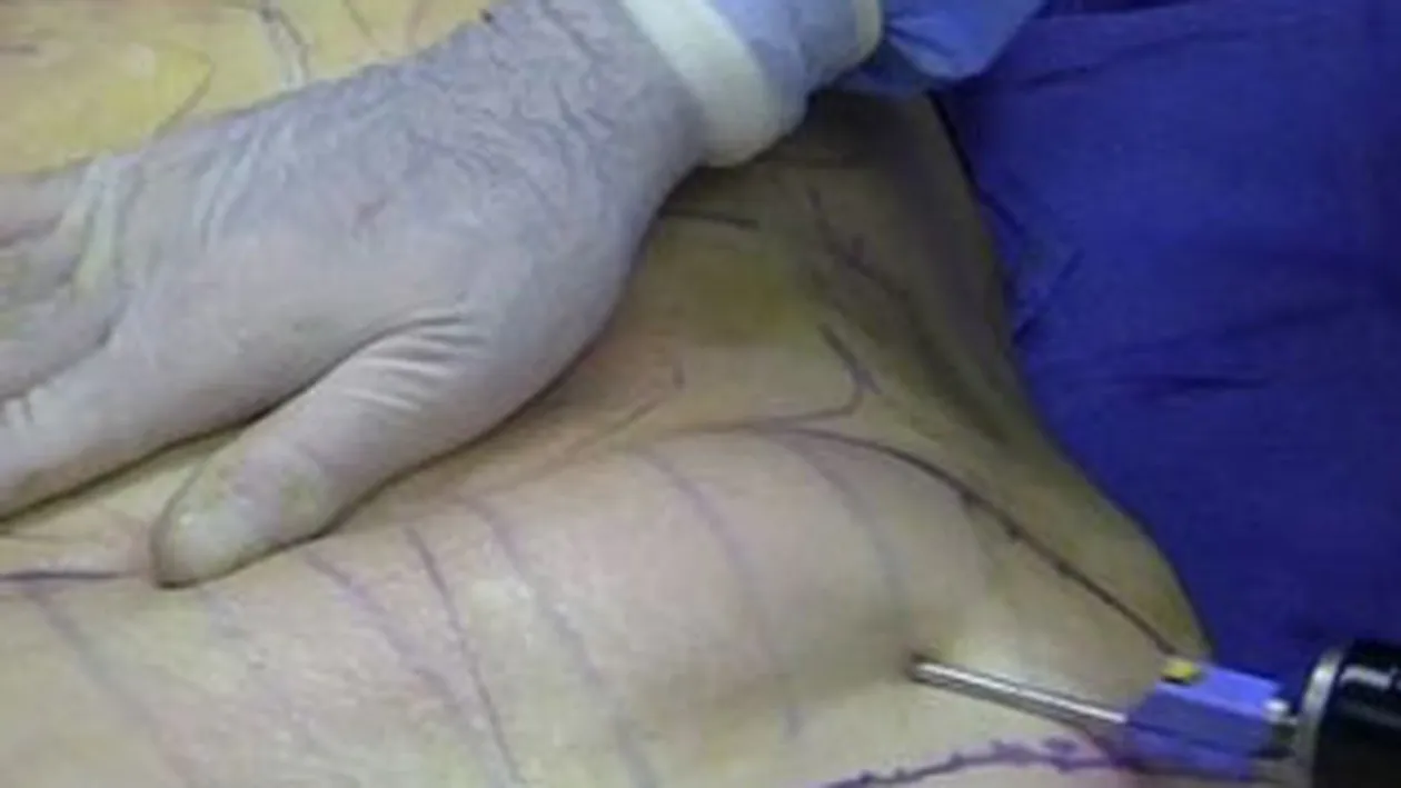 Liporexia, noua obsesie a femeilor care vor sa fie slabe!