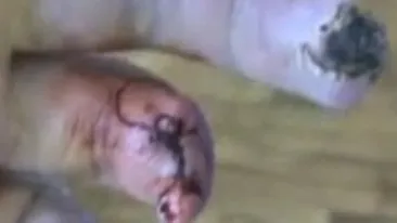 ALERTA! Croco, drogul care putrezeste pielea si muschii, ar putea ajunge in Romania. Vezi aici inregistrari socante cu consumatorii afectati!