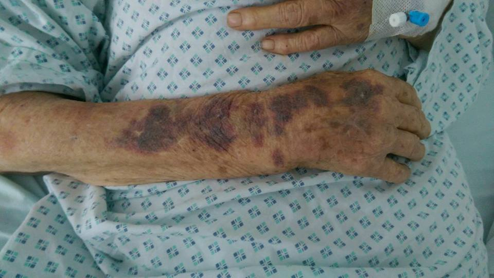 IMAGINI HORROR! Bătrână de 95 de ani, desfigurată cu bâta pentru banii de pensie! Reacţia medicului: ”N-a mai apucat, că…”