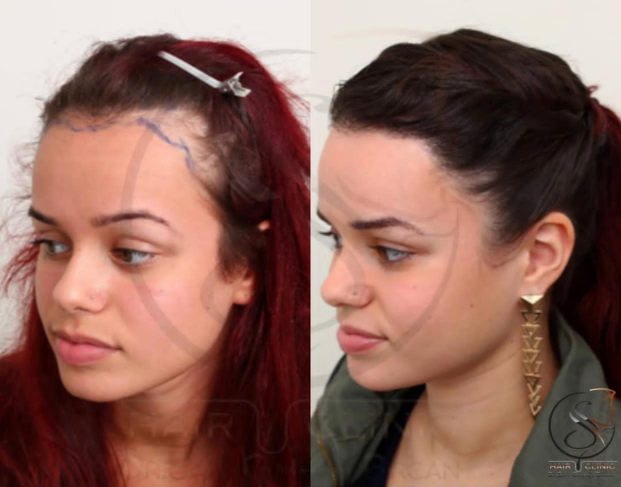 Legacy Med aduce în România inovație în transplantul de păr: implant de păr pentru femei fără a tunde podoaba capilară. Colaborare specială cu Turkey Hair Academy