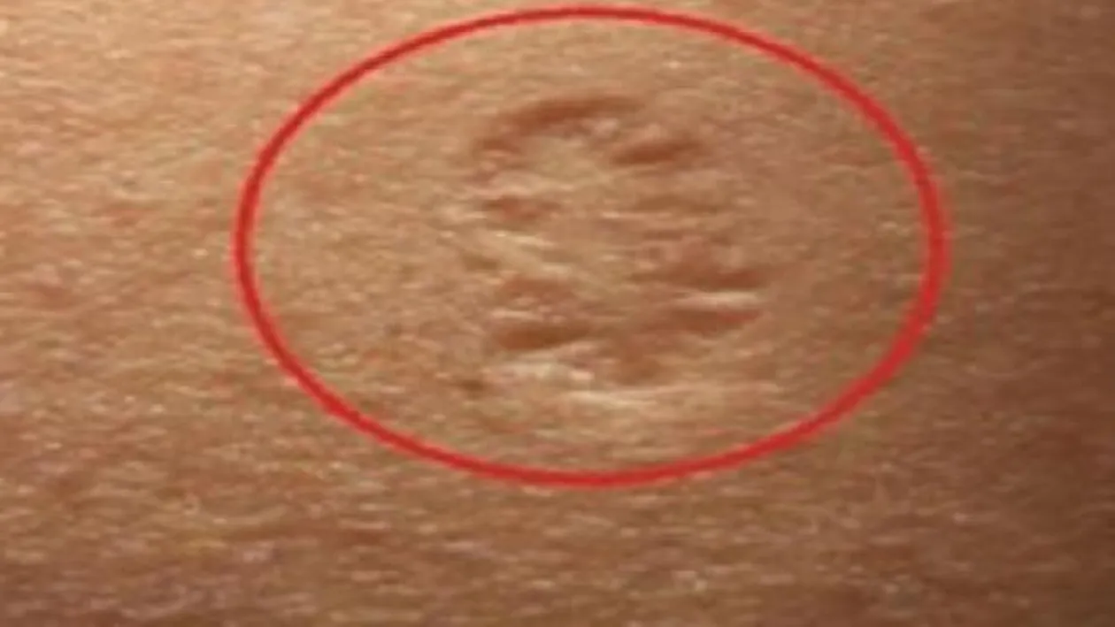 Ai și tu acest semn? Ce reprezintă, de fapt, cicatricea de pe partea superioară a brațului