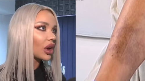 Bianca Drăgușanu, din nou învinețită. Ce spune despre Alex Bodi