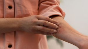 (P) Tratament pentru psoriazis ușor de urmat și integrat în rutina zilnică. Remisie îndelungată și efecte vizibile rapid