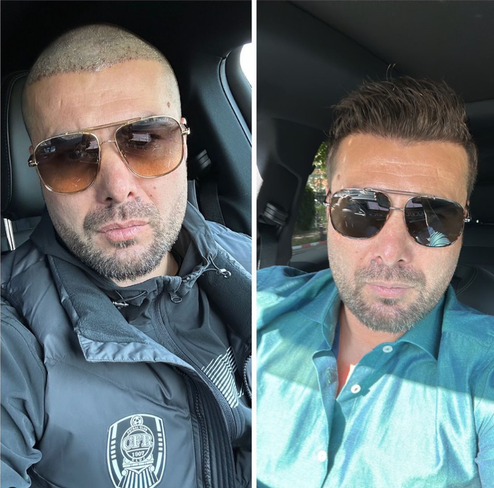 Mutu și-a făcut implant de păr. (sursa: instagram.com)
